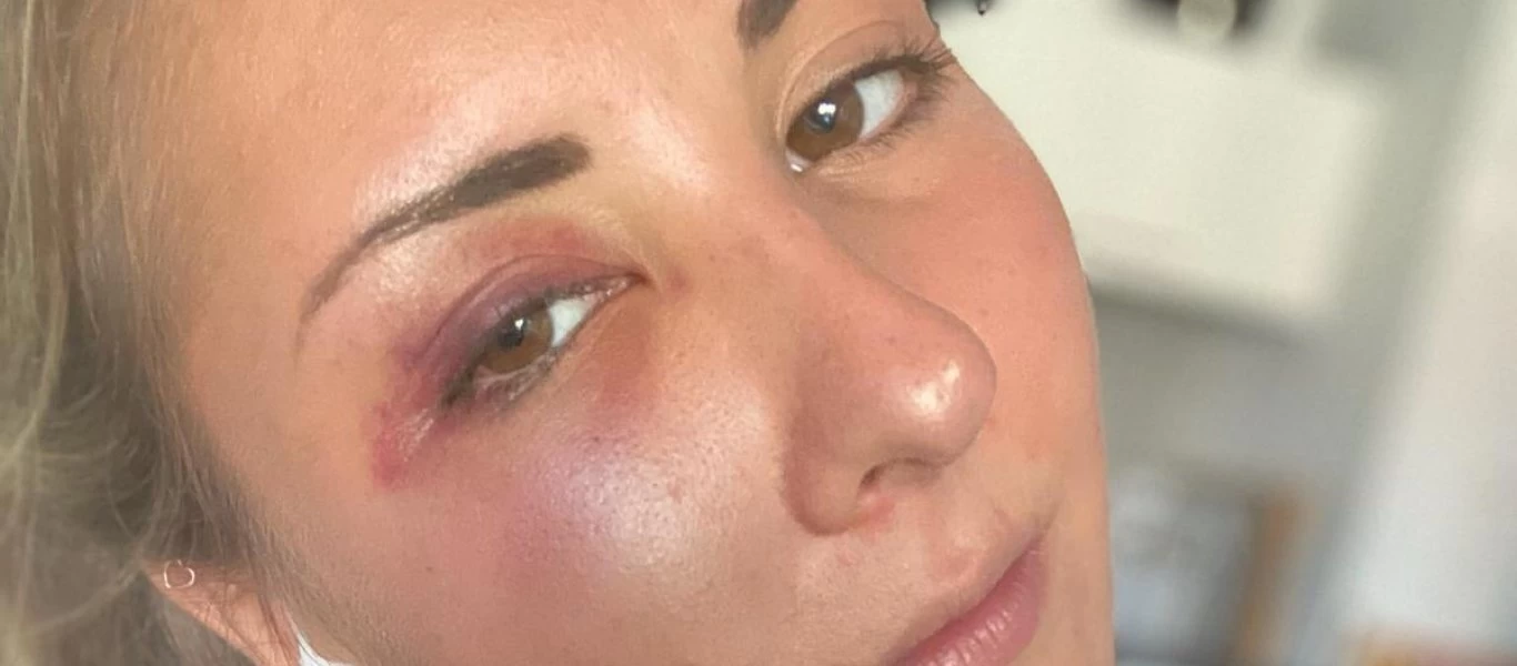 Στρασβούργο: Αλλοδαποί ξυλοκόπησαν κοπέλα γιατί... φόρεσε κόκκινη φούστα! (φώτο)